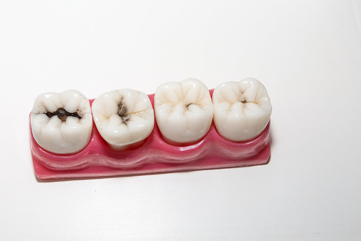 Чем лечат альвеолит зуба