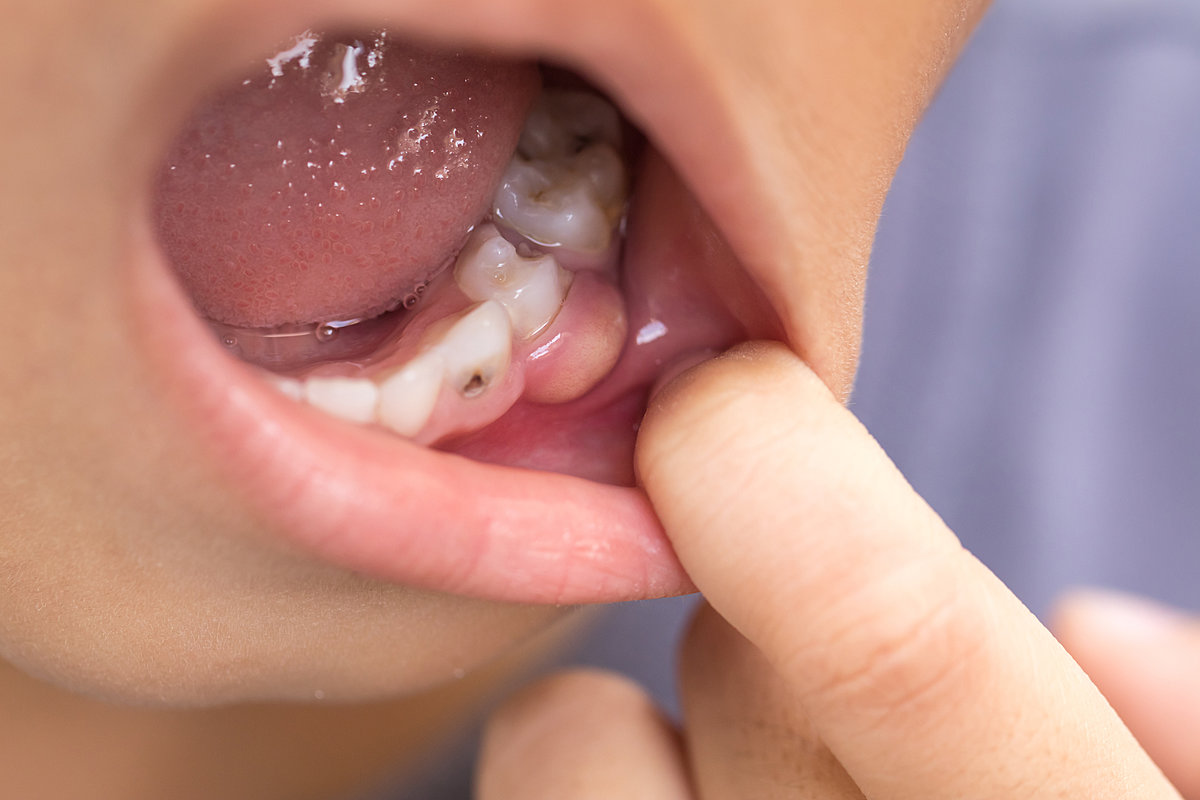 Лечение кариеса молочных зубов у детей, Киев l Стоматологическая клиника 32 Dent