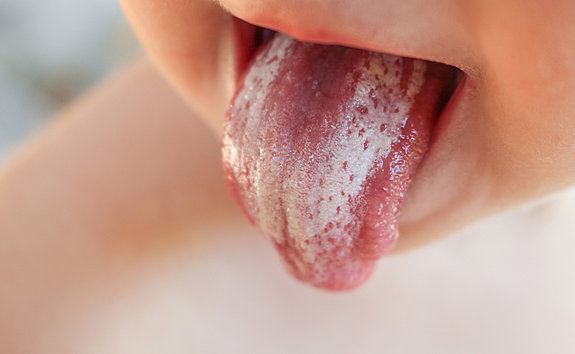 Виды кандидоза полости рта
